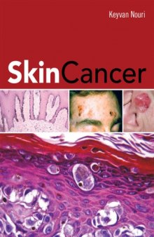 Skin cancer.