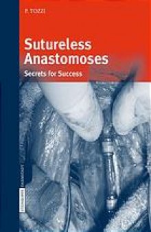 Sutureless anastomoses : secrets for success