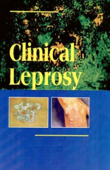 Diagnosis of Leprosy