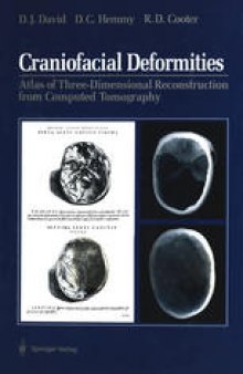 Craniofacial Deformities: Atlas of Three-Dimensional Reconstruction from Computed Tomography