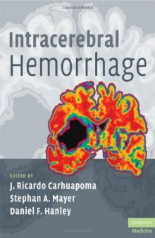 Intracerebral Hemorrhage