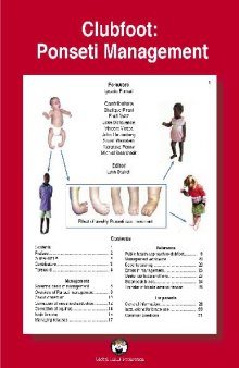 Clubfoot Ponseti Management