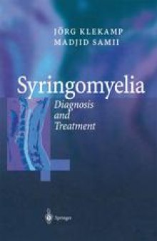 Syringomyelia: Diagnosis and Treatment