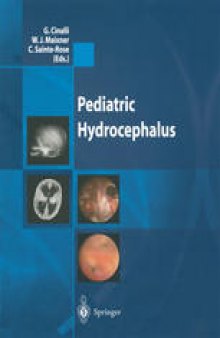 Pediatric Hydrocephalus